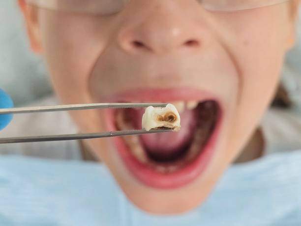 Best Emergency Dentist for Knocked-Out Tooth in Cathcart, WA